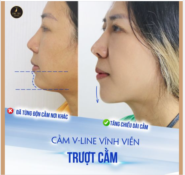 KẾT QUẢ XỨNG ĐÁNG VỚI 7 NGÀY CHỜ MONG SAU PT TRƯỢT CẰM: