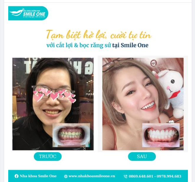 Tạm biệt hở lợi cười tự tin hơn với răng sứ thẩm mỹ.