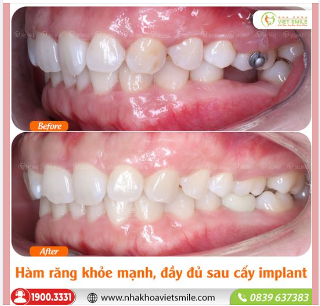 KHỚP CẮN TỐT SAU CẤY IMPLANT RĂNG SỐ 6 ĐÃ MẤT