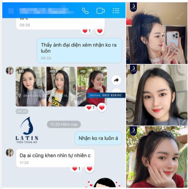 Em gái tự tin với dáng mũi cấu trúc sau 6 tháng
