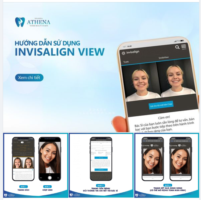 4 BƯỚC SỬ DỤNG CÔNG NGHỆ BIẾT TRƯỚC NỤ CƯỜI SAU NIỀNG RĂNG SMILE VIEW