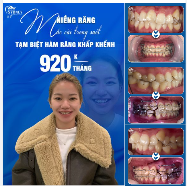 NIỀNG RĂNG KHẤP KHỂNH HIỆU QUẢ CAO TẠI NHA KHOA HÀ NỘI SYDNEY