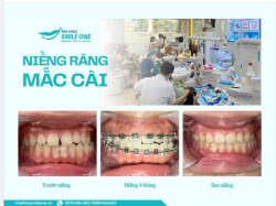 Nếu bạn đang gặp vấn đề về răng miệng, nhắn tin ngay đến nha khoa Smile One để được các bác sĩ tư vấn và thăm khám miễn phí nhé!