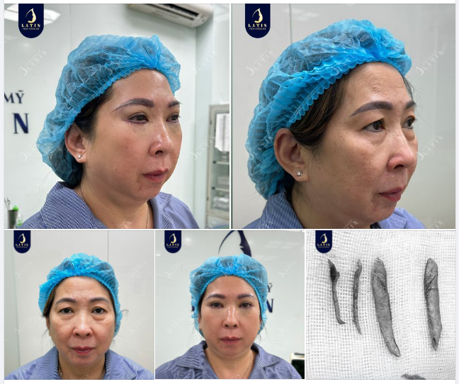 Thời gian trôi đi, khuôn mặt chúng ta sẽ xuất hiện nhiều dấu vết lão hóa như nếp nhăn, vết chân chim...đặc biệt là quanh vùng da mắt.