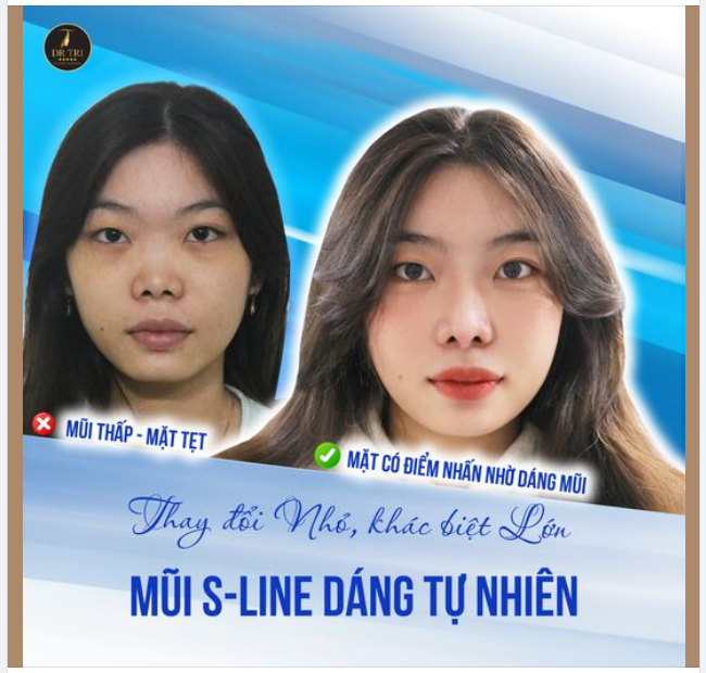 DÁNG MŨI SLINE TỰ NHIÊN- TẠO ĐIỂM NHẤN CHO GƯƠNG MẶT TẸT!