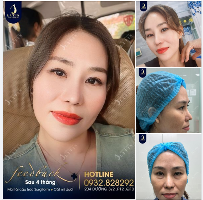 Chị gái xinh đẹp sau 4 tháng tái tạo dáng mũi mới