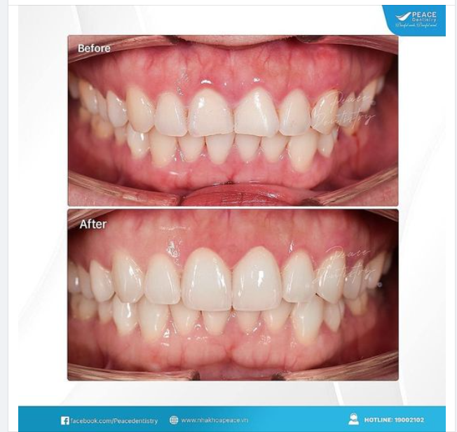 MẺ RÌA CẮN - CHUYỆN HAY GẶP NHƯNG DỄ BỎ QUA!