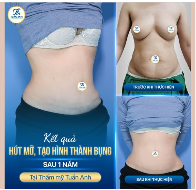 Cả nhà cùng so sánh ảnh trước và kết quả sau 1 năm phẫu thuật hút mỡ và tạo hình thành bụng của chị khách hàng này nhé: