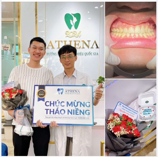 Chúc mừng Nguyễn Văn Chiến vừa hoàn thành hành trình tháo niềng thành công!