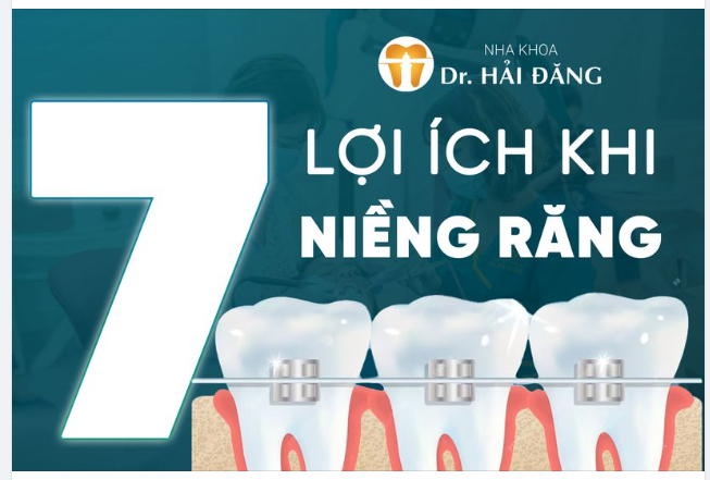 7 lợi ích vàng khi niềng răng