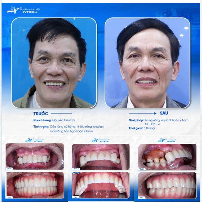 TIN VÀO CÔNG NGHỆ TRỒNG RĂNG IMPLANT HIỆN ĐẠI, CUỘC SỐNG CỦA BỆNH NHÂN MẤT RĂNG BƯỚC SANG TRANG MỚI