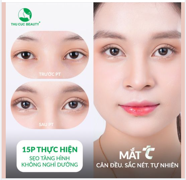 Cắt mí sẹo tàng hình chỉ 15P, 3 ngày hồi phục. Nếp mí chuẩn tự nhiên
