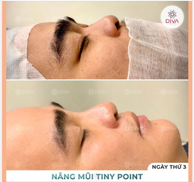 MŨI GÃY SÂU NGANG MẮT: PHƯƠNG PHÁP NÀO CẢI THIỆN TỐT NHẤT?