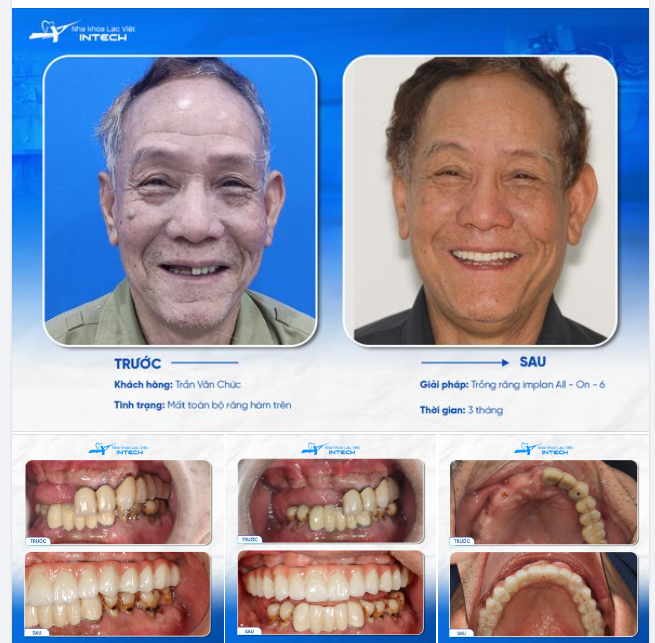 NGƯỜI ĐÀN ÔNG GẶP BIẾN CHỨNG CẦU RĂNG SỨ ĐÃ TÌM RA LỐI THOÁT NHỜ ĐIỀU NÀY