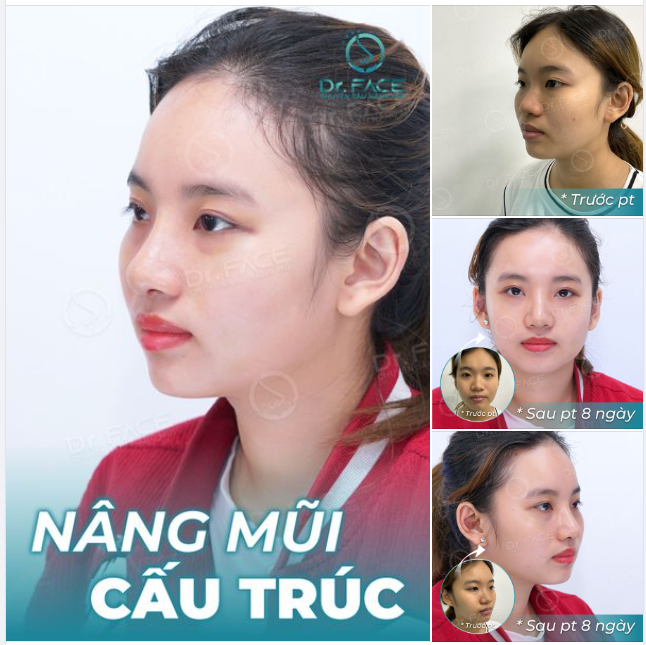 NÂNG MŨI BỊ SƯNG RỒI SAO ĐI LÀM