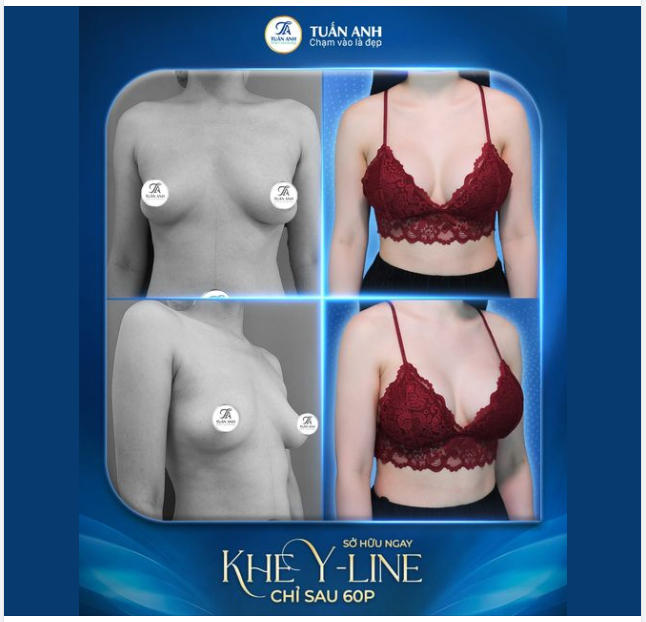 Bác sĩ Tuấn Anh CKI với hơn 16 năm kinh nghiệm - Top đầu ngành phẫu thuật thẩm mỹ sẽ giúp bạn sở hữu: