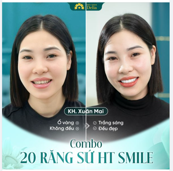 Combo 20 răng sứ HT Smile giải quyết tình trạng răng xỉn màu, răng không đều cho chị Phạm Xuân Mai (Hải Phòng).