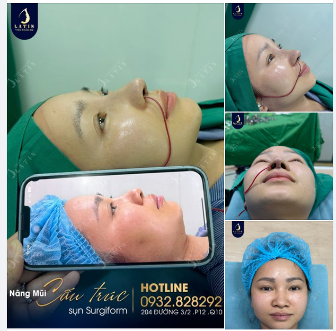 Tại sao chị gái quyết tâm từ Cần Thơ lên Sài Gòn nâng mũi