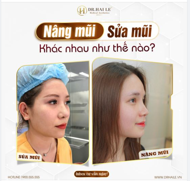 Nâng mũi khác sửa mũi như thế nào?