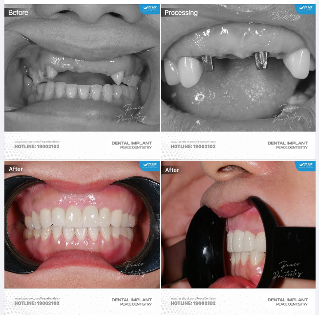 IMPLANT VÙNG RĂNG CỬA - GIẢI ĐÁP NHANH MỘT SỐ CÂU HỎI PHỔ BIẾN TỪ KHÁCH HÀNG: