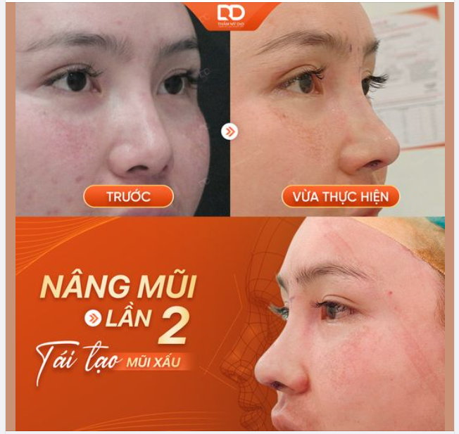NÂNG MŨI LẦN 2 - TÁI TẠO MŨI XẤU