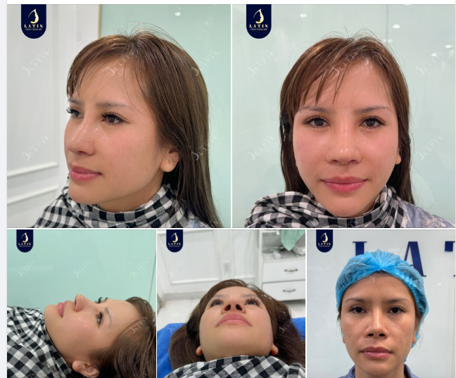 Cùng xem ngay kết quả mũi cấu trúc sửa lại sau 10 ngày