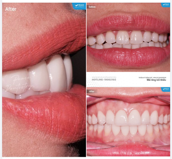 SMILE MAKEOVER VENEER MỎNG VÀ MÀI RĂNG TỐI THIỂU