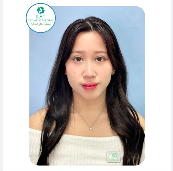 Cách chăm sóc sau khi nhấn mí mắt không sưng hiệu quả