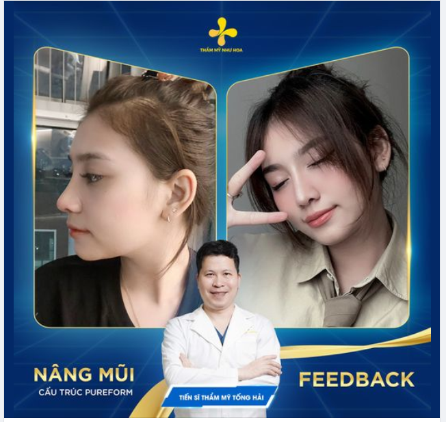 FEEDBACK NÂNG MŨI CẤU TRÚC PUREFORM