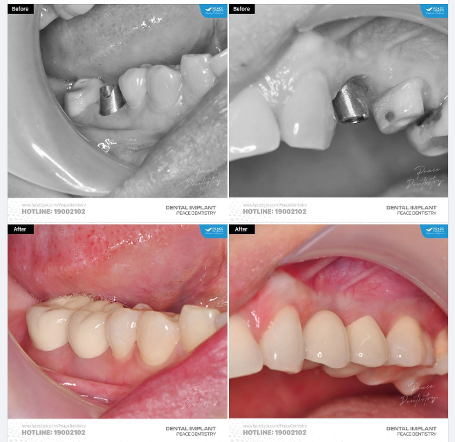 CA LÂM SÀNG IMPLANT: Phục hồi R46 và R24 với sự chỉn chu, tối ưu về thẩm mỹ, chức năng và độ vững ổn lâu dài cho khách hàng.