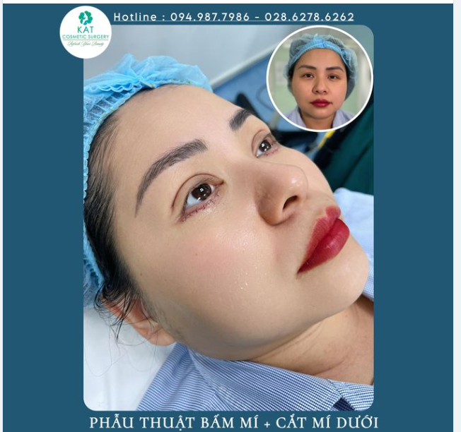 Dành cho những cơ địa có bọng mắt dưới to tích tụ túi mỡ và da dư nhưng mi mắt trên lại không đều, không rõ mí và chưa xuất hiện tình trạng da chùn hay sụp mí quá nhiều.