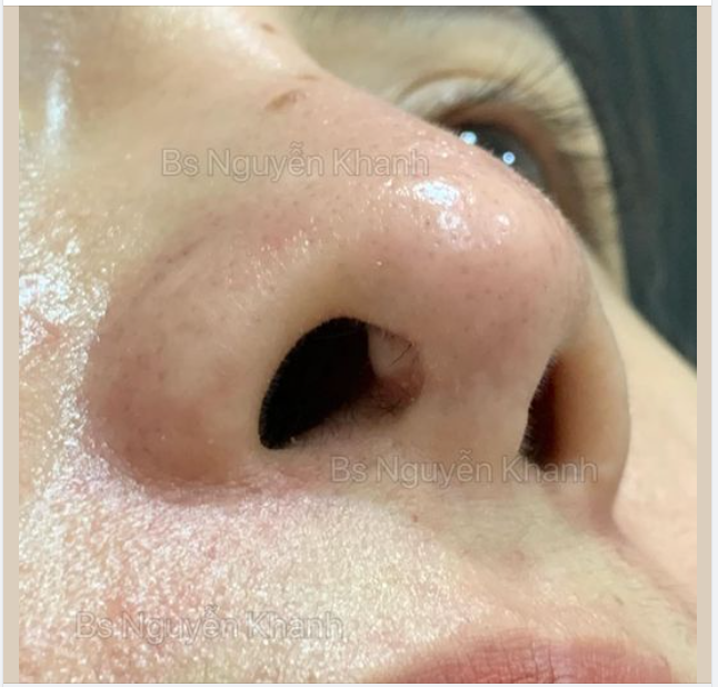 BÊN TRONG MŨI XUẤT HIỆN CỤC NHỎ SAU NÂNG MŨI - LIỆU CÓ PHẢI LÀ BIẾN CHỨNG?