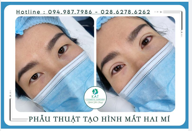 Cuối tuần rạng rỡ hơn với đôi mắt hai mí chỉ sau 15 phút phẫu thuật 