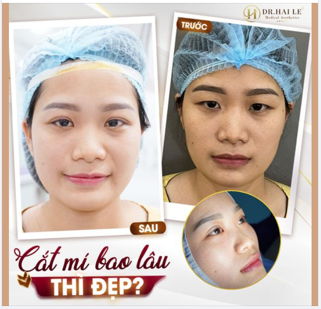Cắt mí bao lâu thì đẹp