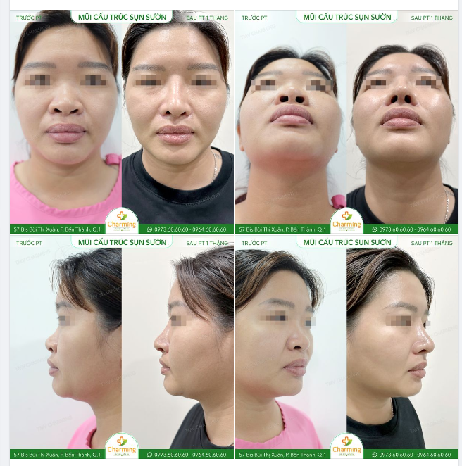 Đây là một trường hợp mà mọi người có thể thấy rõ được hiệu quả của phẫu thuật nâng mũi cấu trúc sụn sườn.