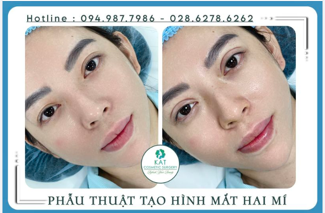 Tại sao có nhiều bạn nhấn mí ngay cả khi đã sở hữu đôi mắt hai mí? 