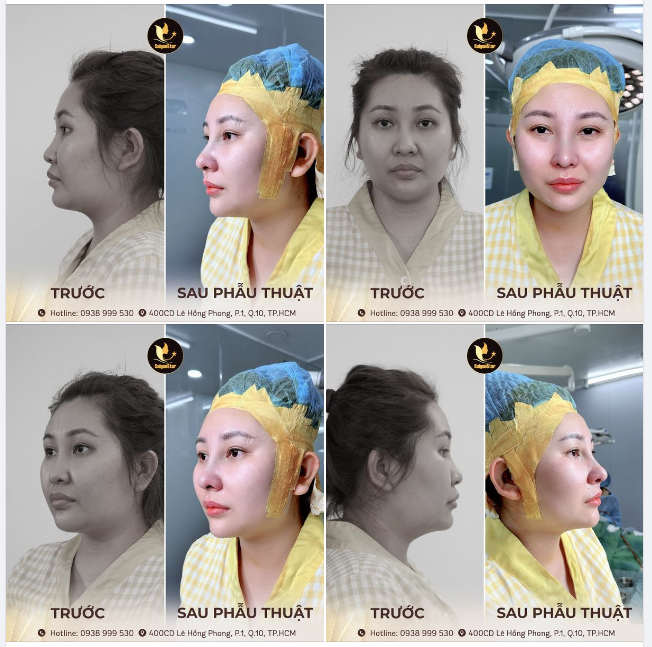 Nâng mũi xong Không sưng – Không đau là có thật