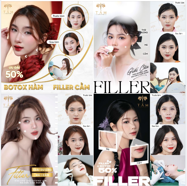 Trải nghiệm ngay bộ đôi thẩm mỹ đỉnh cao BOTOX THON GỌN HÀM và FILLER hot nhất tại TMV Tấm