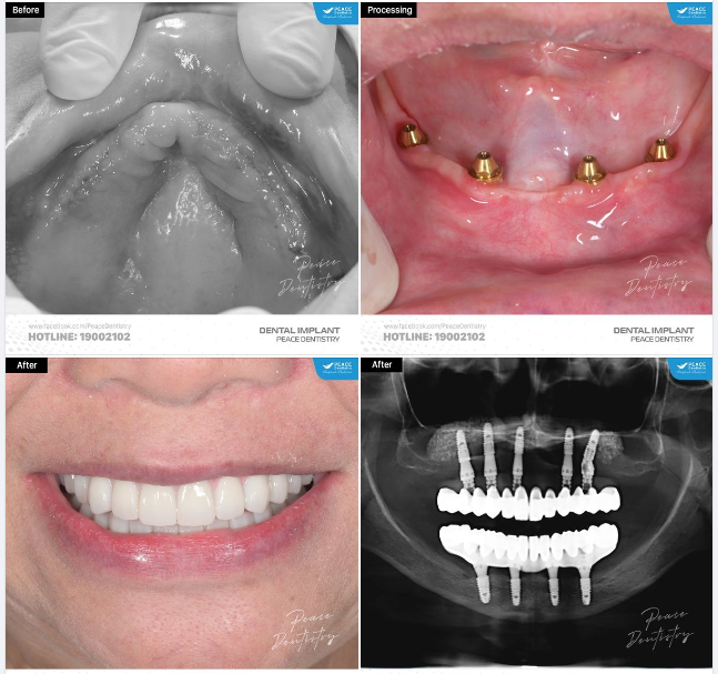 ALL-ON-4 IMPLANT IMPLANT TOÀN HÀM