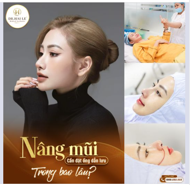 Sau nâng mũi phải đặt ống dẫn lưu bao lâu?