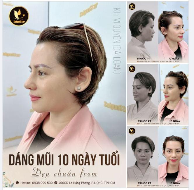 DÁNG MŨI 10 NGÀY TUỔI – ĐẸP CHUẨN FORM