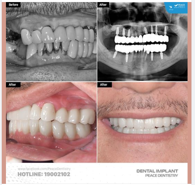 Ca lâm sàng với 11 đơn vị implant giúp chú khách hàng Việt Kiều Mỹ khôi phục trọn vẹn chức năng ăn nhai và nâng cao thẩm mỹ nụ cười.