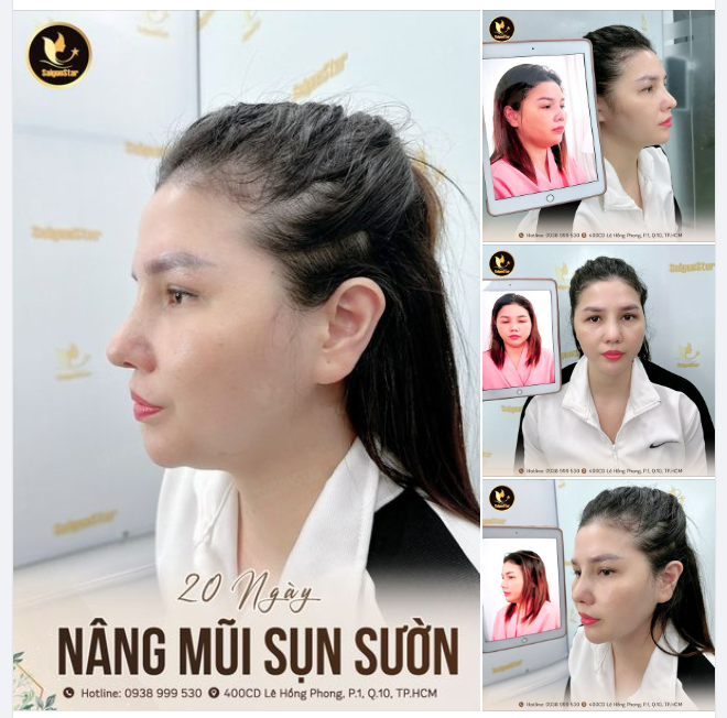 20 NGÀY NÂNG MŨI SỤN SƯỜN