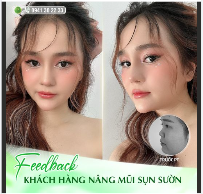 MŨI TO, DÀY THỊT SAU KHI NÂNG SẼ BIẾN ĐỔI NHƯ THẾ NÀO? 