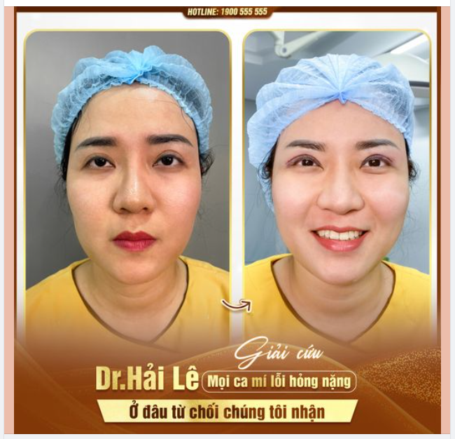Lựa chọn Dr.Hải Lê HCM sửa mí sau một thời gian dài chịu đựng những buồn phiền, những khó chịu mà mí lỗi hỏng mang lại, chị khách nhận về cho mình cho mình cái kết “hài lòng vô cùng”.