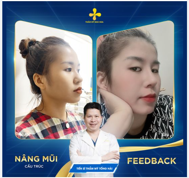 Một chút thay đổi sương sương trên chiếc mũi giúp khuôn mặt thanh tú hơn