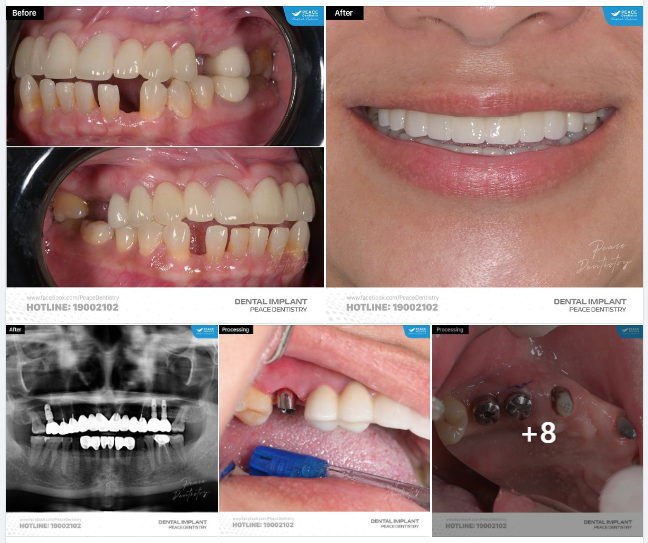 TRỒNG RĂNG IMPLANT NÂNG XOANG KÍN  GHÉP XƯƠNG GBR