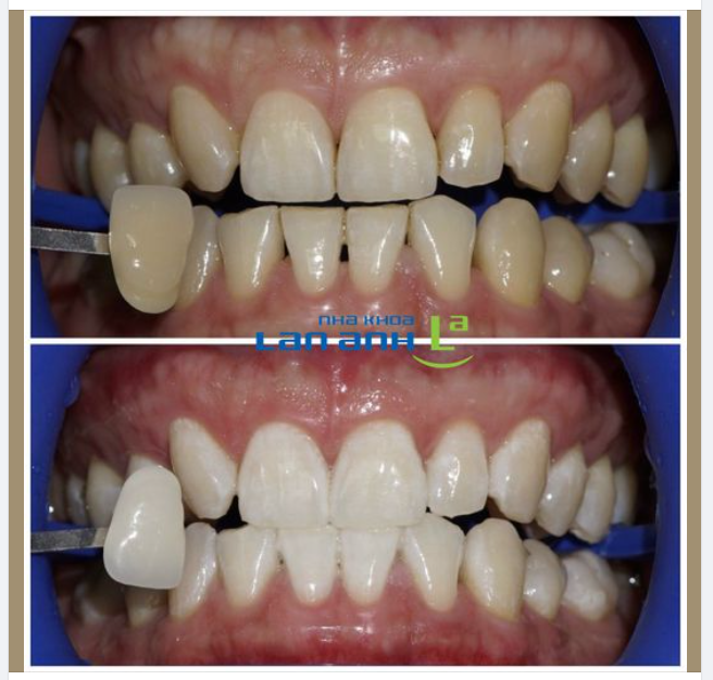 Cạo vôi răng và Tẩy trắng răng khác nhau như thế nào