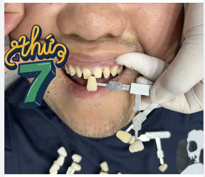 6 LỢI ÍCH “TO LỚN” CỦA BỌC RĂNG SỨ THẨM MỸ