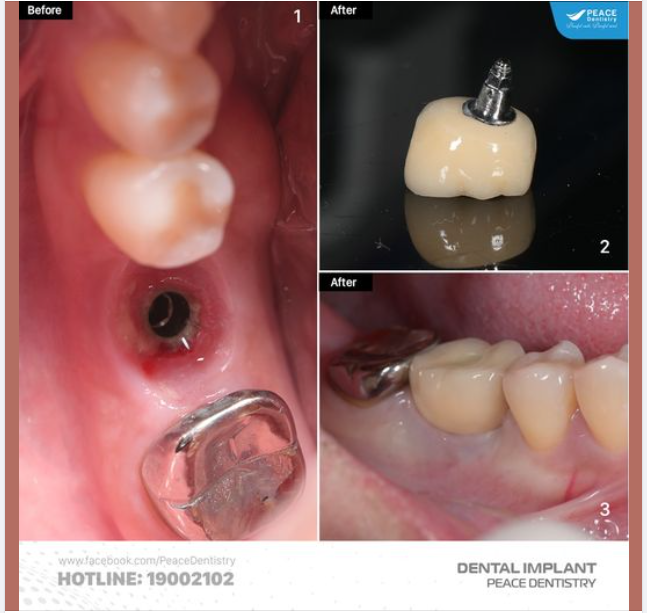 CẬN CẢNH PHỤC HÌNH TRÊN IMPLANT